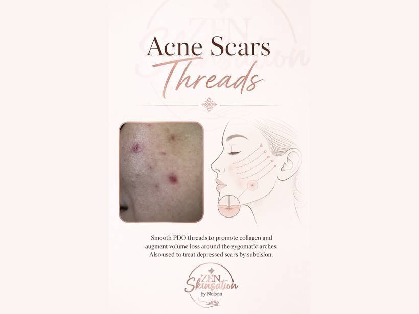 Acne Scars PDO Threads at Zenskinsation