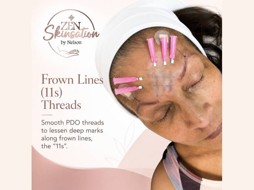 Frown Lines PDO Threads at Zenskinsation