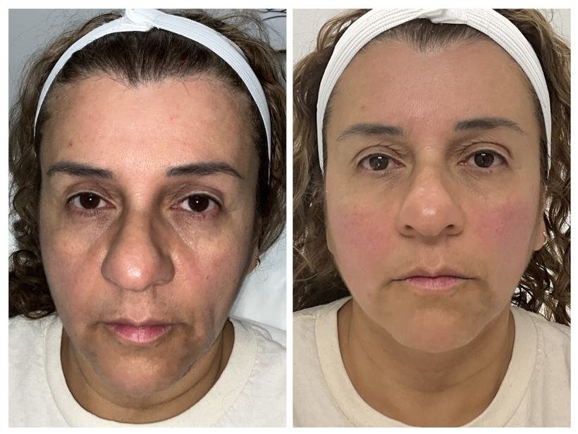 Before and after result — Zenskinsation