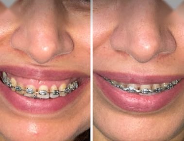Before and after result — Zenskinsation