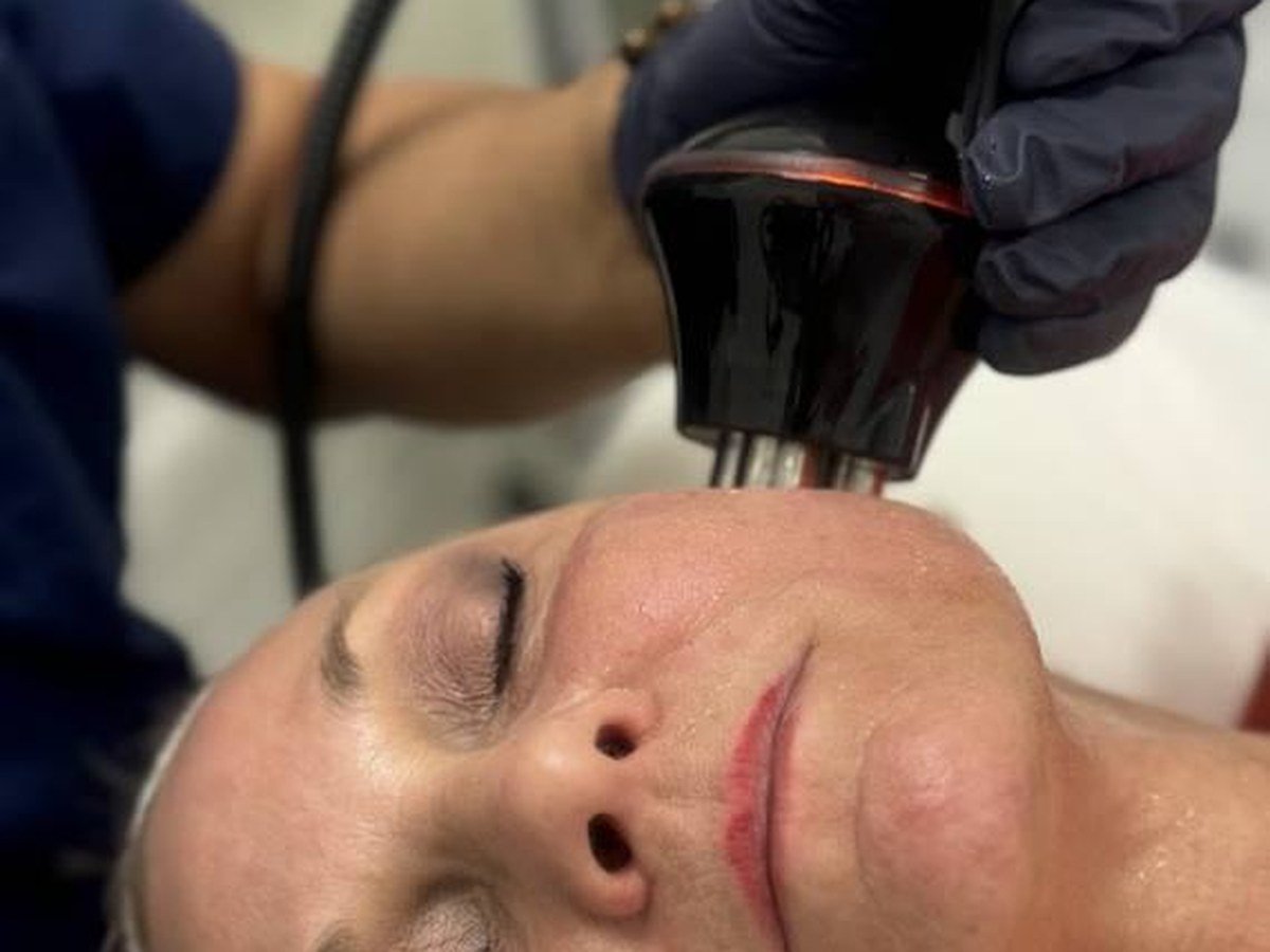 TriLift®: the non-surgical facelift, explained